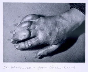 Dr. Atkinsons erfrorene Hand, 1911